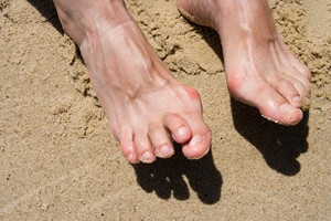 Can Hammertoe Be Cured?