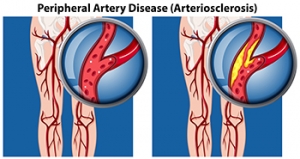 PAD Symptoms and Risk Factors
