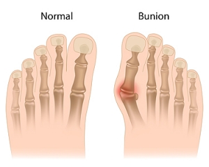 What to Know About Bunions